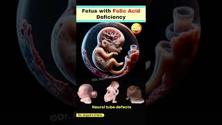 How Folic Acid Deficiency Leads to Neural Tube Defects in Pregnancy shortsviral pregnancy vitamin [upl. by Wivina711]