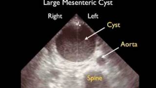 How To Aorta Ultrasound  Aneurysms Case Study Video [upl. by Rosabelle]