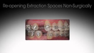 Reversing Previous Orthodontic Treatment [upl. by Arual]