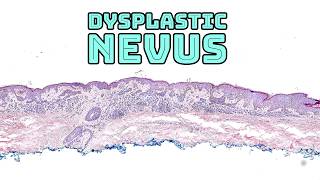 Dysplastic nevus quotatypical skin molequot under the microscope pathology dermpath dermatology [upl. by Adorne]