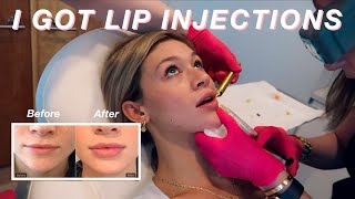 I GOT LIP INJECTIONS  My Lip Filler Experience  Before During  After [upl. by Niattirb725]