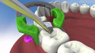 Class II composite restoration using V3 Sectional Matrix System  Triodent [upl. by Nosyaj214]