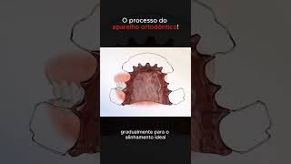 Aparelhos ortodônticos curiosidades curiosidadesmundiais fatoscuriosos mundocurioso ciencia [upl. by Pulchi710]