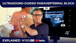 ULTRASOUNDGUIDED PARAVERTEBRAL BLOCK [upl. by Anyak17]