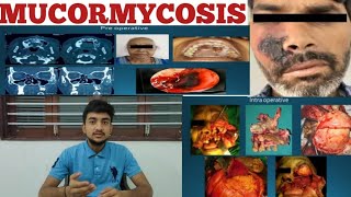 All about MUCORMYCOSIS  Dr Bhava  Treatment amp management of mucormycosis [upl. by Milak]