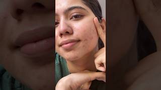 Acne treatment dry skin and peeling skincareforacneproneskin ytshortsindia [upl. by Nnylsoj182]