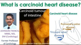 What is carcinoid heart disease [upl. by Ruffo261]