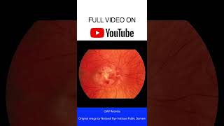 CMV Retinitis Fundoscopy [upl. by Audrey]