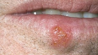 DermTV  How Long Are Cold Sores Contagious DermTVcom Epi 397 [upl. by Gypsie203]