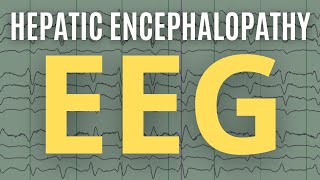 Triphasic Waves of Hepatic Encephalopathy on EEG  more [upl. by Saltsman]