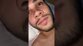 Minoxidil beard transformation [upl. by Eanel37]