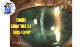 What is Fuchs Endothelial Dystrophy Eye Dr Explains 2023 [upl. by Nylaras]