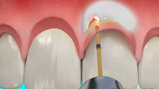 Dental Treatment  Osseous Crown Lengthening with Waterlase Laser Dentistry [upl. by Alick]