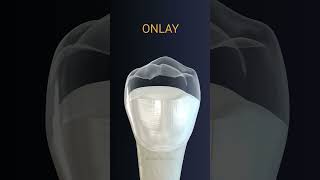 Onlay dental crown [upl. by Brannon625]