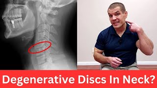 3 Exercises For Cervical Degenerative Disc Disease Relieve Neck Pain [upl. by Erlina729]