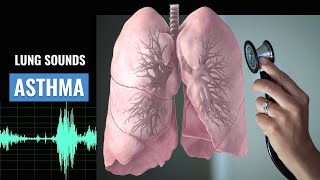 Asthma Lung sound  Wheezing  Asthma  Christina NP  Caring Casa [upl. by Eerdna]