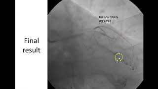 StentΛBalloon Technique for LAD ostial lesion 1 [upl. by Siddra]