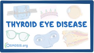 Thyroid Eye Disease causes symptoms diagnosis treatment pathology [upl. by Nasaj]