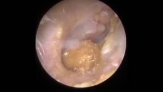 Ear Wax Removal Leicester  Mr Neel Raithatha The Hear Clinic [upl. by Annad]