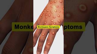 Monkeypox Symptoms  Mpox mpox monkeypox shorts [upl. by Nayab383]