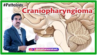 Craniopharyngioma Quick review  Pathology USMLE Step 1 [upl. by Assenyl841]