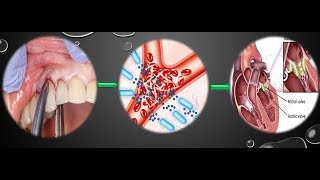 Infective Endocarditis and its dental consideration [upl. by Alfred328]