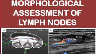 Morphological assessment of lymph nodes [upl. by Hardigg]