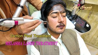 melasma laser treatment Carbon Peel Laser  4k video [upl. by Annal]