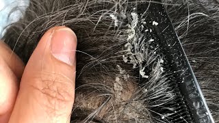 DANDRUFF REMOVAL FROM SCALP [upl. by Trebma335]