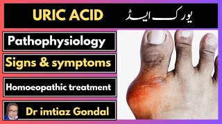 uric acid treatment in homeopathy Dr imtiaz Gondal [upl. by Jelle595]