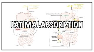 Approach to Fat malabsorption  signs and symptoms and causes [upl. by Yorled980]