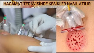 HACAMAT TEDAVİSİNDE KESİK ATMA NASIL YAPILIR [upl. by Franza]