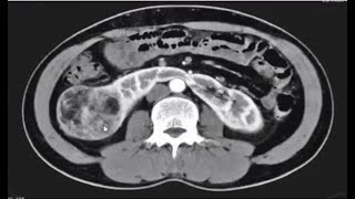 40 case of genitourinary Sportters Radiology casesradiopediafrcrexamsctmriIVPACUXrayCTUT [upl. by Moscow]