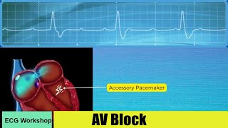 AV Block ECG features and Comparison with ECG simulator [upl. by Parsifal]