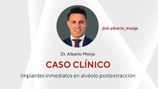 Caso Implantes inmediatos en alvéolo postextracción  Dr Alberto Monje [upl. by Yauq]