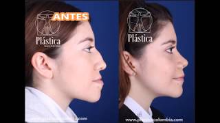 Fotos de antes y después  Paciente Procedimiento Maxilofacial con Rinoplastia [upl. by Drofliw349]