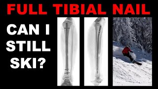 FULL TIBIAL NAIL  Can I still ski  One year postsurgery [upl. by Sansbury798]