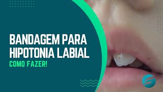 Bandagem para hipotonia labial [upl. by Lleinad]