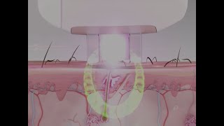 elos Hair Removal biological animation [upl. by Remmer]