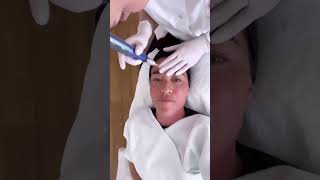 SkinPen microneedling behandeling in Amsterdam met Naomi van As [upl. by Llerot745]