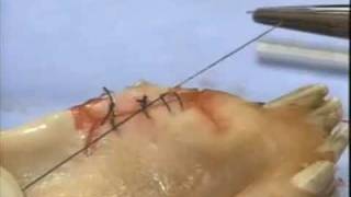 Introduction to Periodontal Surgery Techniques Initial Incisions and Suturing [upl. by Aitsirhc942]