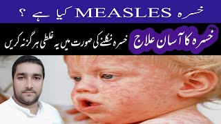 Measles causes symptoms and treatment in UrduHindikhasra ka ilajMeasles treatmentخسرہ کا علاج [upl. by Anytsirhc]