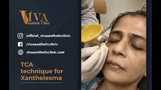 TCA technique for Xanthelasma  Dr Deepam Shah  Dermatologist in South Mumbai [upl. by Koch]