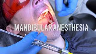 Techniques for Mandibular Anaesthesia  VaziraniAkinosi Mandibular Block Technique dentist dental [upl. by Linea]