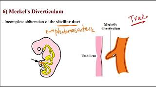 USMLE ACE Video 157 Common Gastrointestinal Disorders [upl. by Noswad]