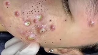 Big Cystic Acne Blackheads Extraction Blackheads amp Milia Whiteheads Removal Pimple Popping  9129 [upl. by Francisco]