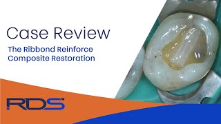 The Ribbond fiber reinforce composite restoration [upl. by Owades701]