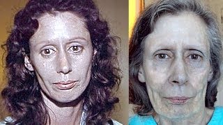 Womans Skin Turns Silver For 60 Years  Rosemary Jacobs [upl. by Nuahsel]