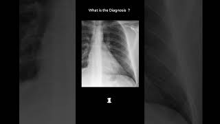 Pericardial fat pad 139 Cardiac disease chest xray Quiz radiologychannel007 [upl. by Aleta626]