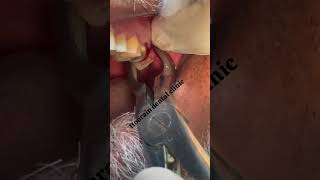 upper 3rd molar Extraction [upl. by Gibert]